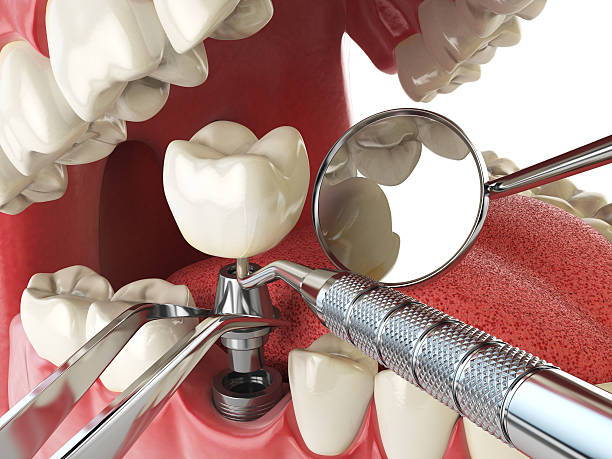 Best Emergency Root Canal Treatment in Three Forks, MT